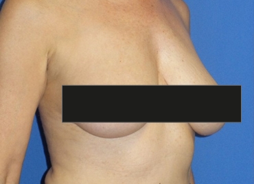 DrBrucker-Breast-Lift_before and after gallery widget1