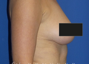 DrBrucker-Breast-Lift_before and after gallery widget2