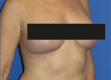 DrBrucker-Breast-Lift_before and after gallery widget3