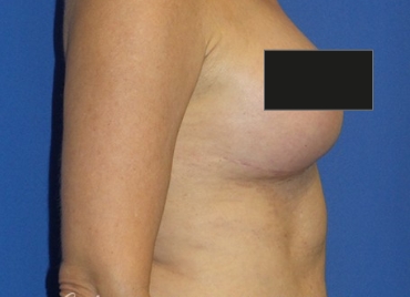 DrBrucker-Breast-Lift_before and after gallery widget4