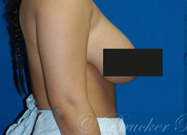 DrBrucker-Breast-Reduction_before and after gallery widget1