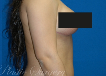 DrBrucker-Breast-Reduction_before and after gallery widget2