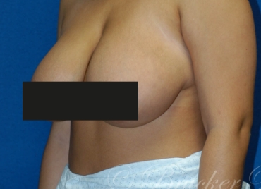 DrBrucker-Breast-Reduction_before and after gallery widget3