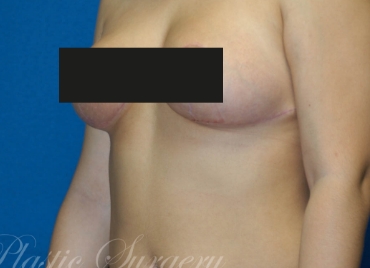 DrBrucker-Breast-Reduction_before and after gallery widget4