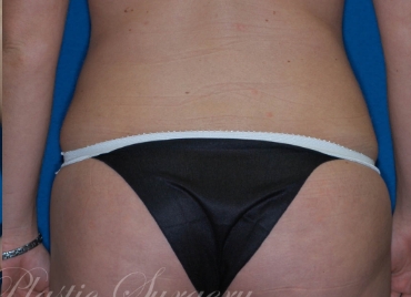 DrBrucker-Liposuction_before and after gallery widget2