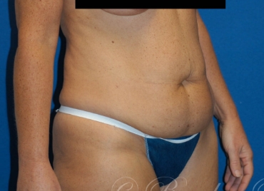 DrBrucker-Tummy-tuck_before and after gallery widget1