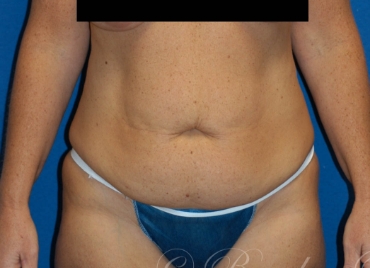 DrBrucker-Tummy-tuck_before and after gallery widget3