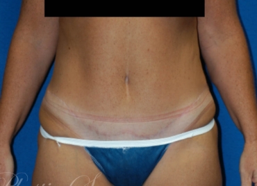 DrBrucker-Tummy-tuck_before and after gallery widget4