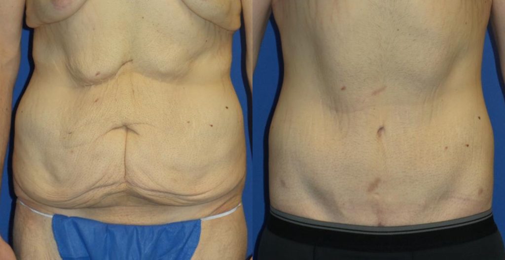 Patient 1e Massive Weight Loss Before and After