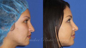 Patient 1c Revision Rhinoplasty Before and After