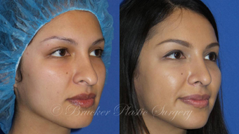 Patient 1a Revision Rhinoplasty Before and After