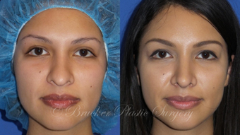 Patient 1b Revision Rhinoplasty Before and After