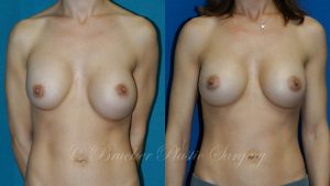 Patient 4a Aesthetic Breast Reconstruction Before and After