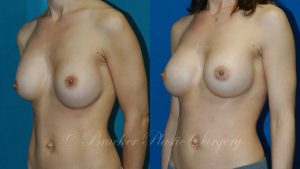 Patient 4b Aesthetic Breast Reconstruction Before and After