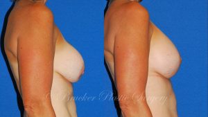 Patient 5b Aesthetic Breast Reconstruction Before and After