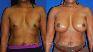 Patient 1a Aesthetic Breast Reconstruction Before and After