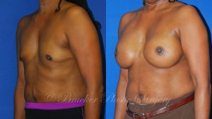 Patient 1b Aesthetic Breast Reconstruction Before and After