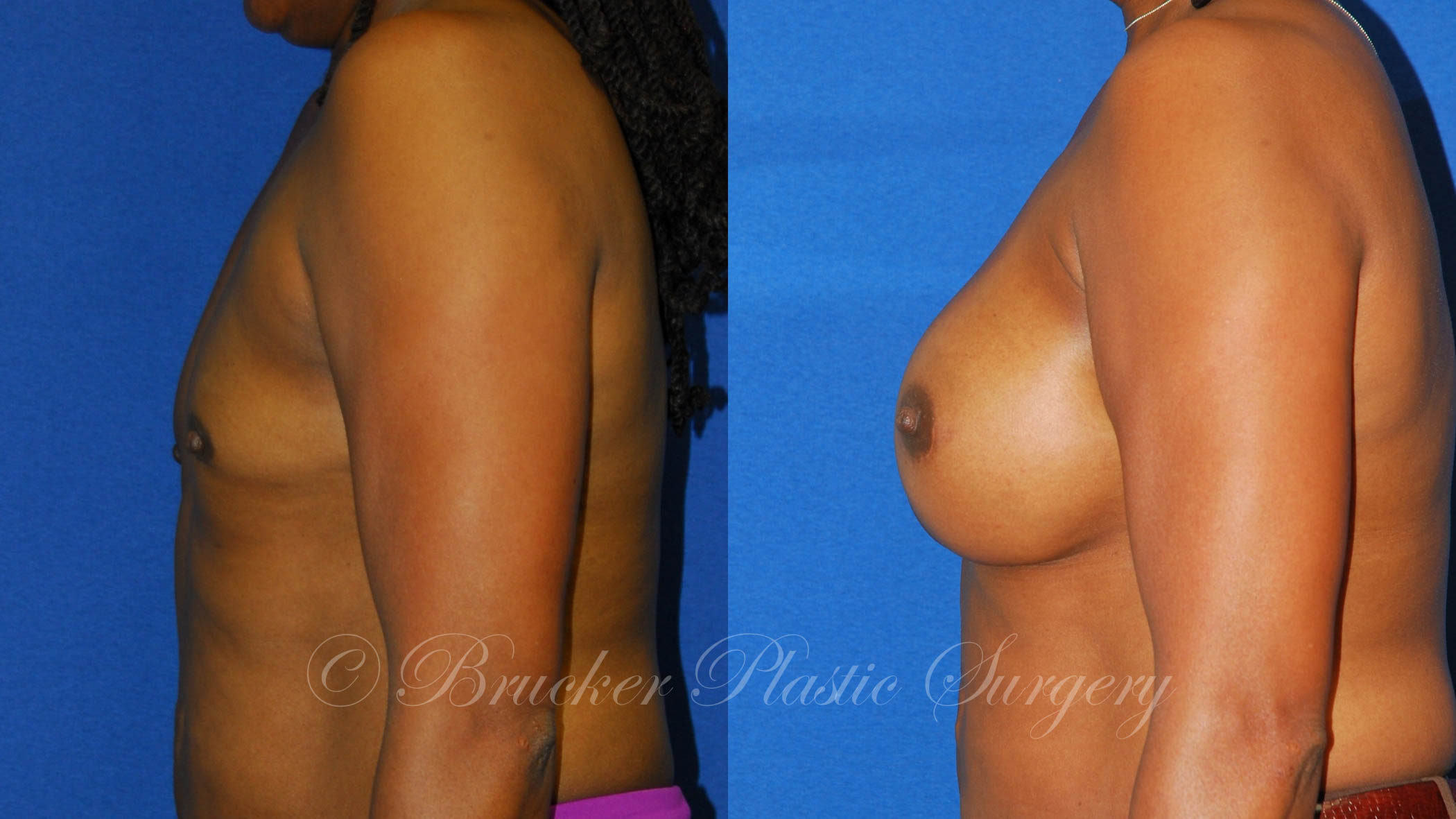 Patient 1c Aesthetic Breast Reconstruction Before and After