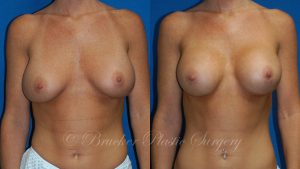 Patient 2a Aesthetic Breast Reconstruction Before and After