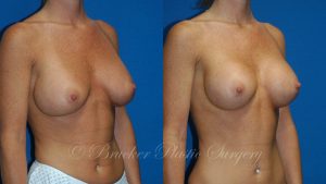 Patient 2b Aesthetic Breast Reconstruction Before and After