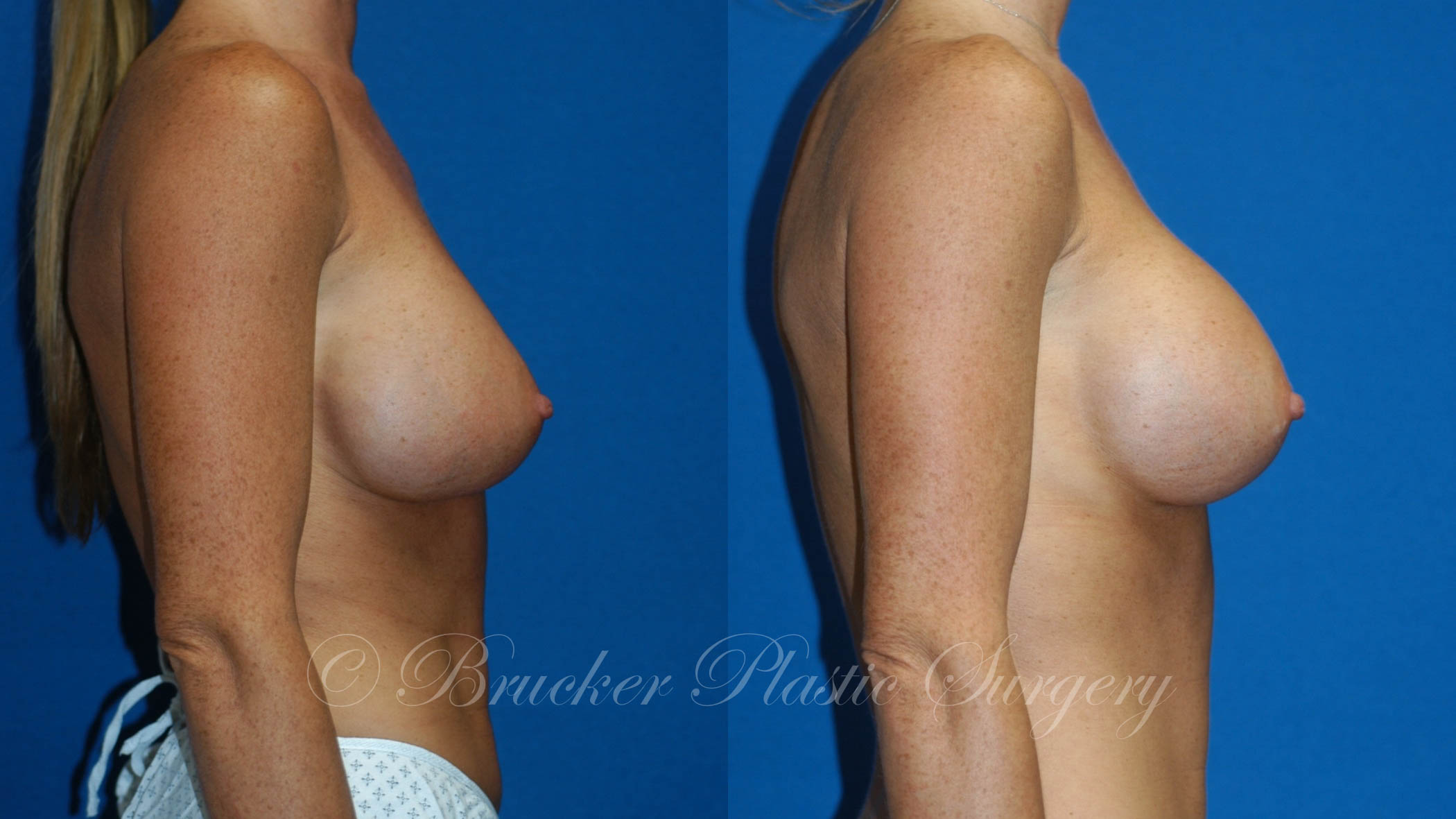 Patient 2c Aesthetic Breast Reconstruction Before and After