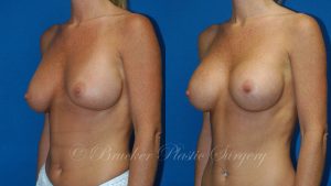 Patient 2d Aesthetic Breast Reconstruction Before and After