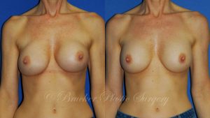 Patient 3a Aesthetic Breast Reconstruction Before and After