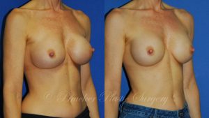 Patient 3b Aesthetic Breast Reconstruction Before and After