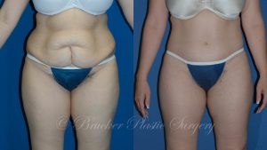 Patient 3a Body Lift Before and After