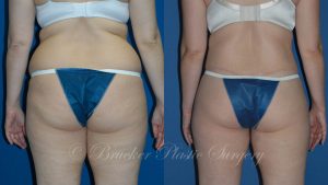 Patient 3b Body Lift Before and After