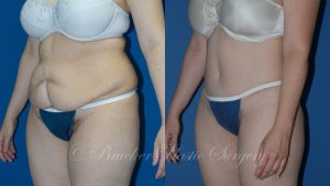 Patient 3c Body Lift Before and After