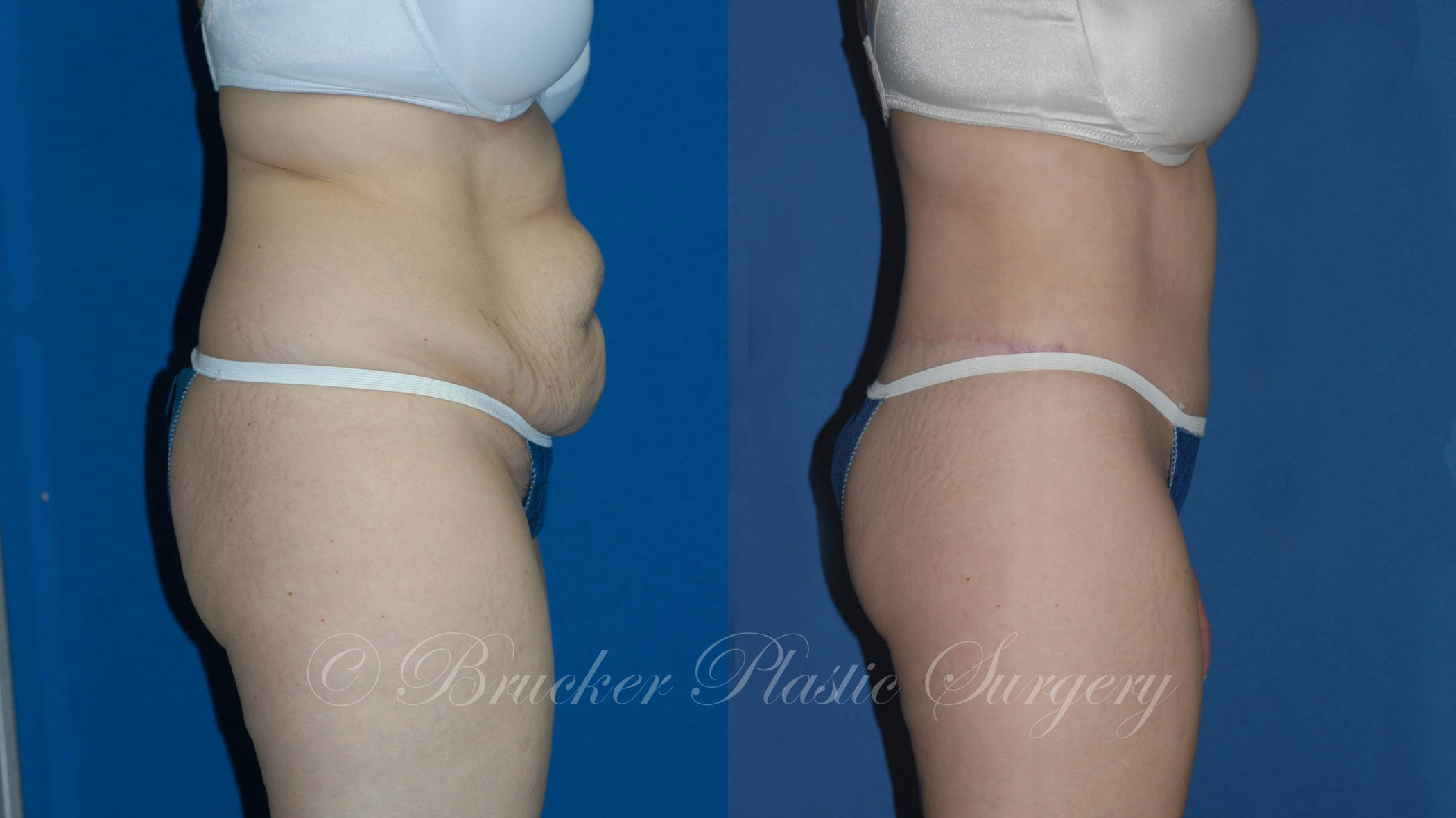 Patient 3d Body Lift Before and After