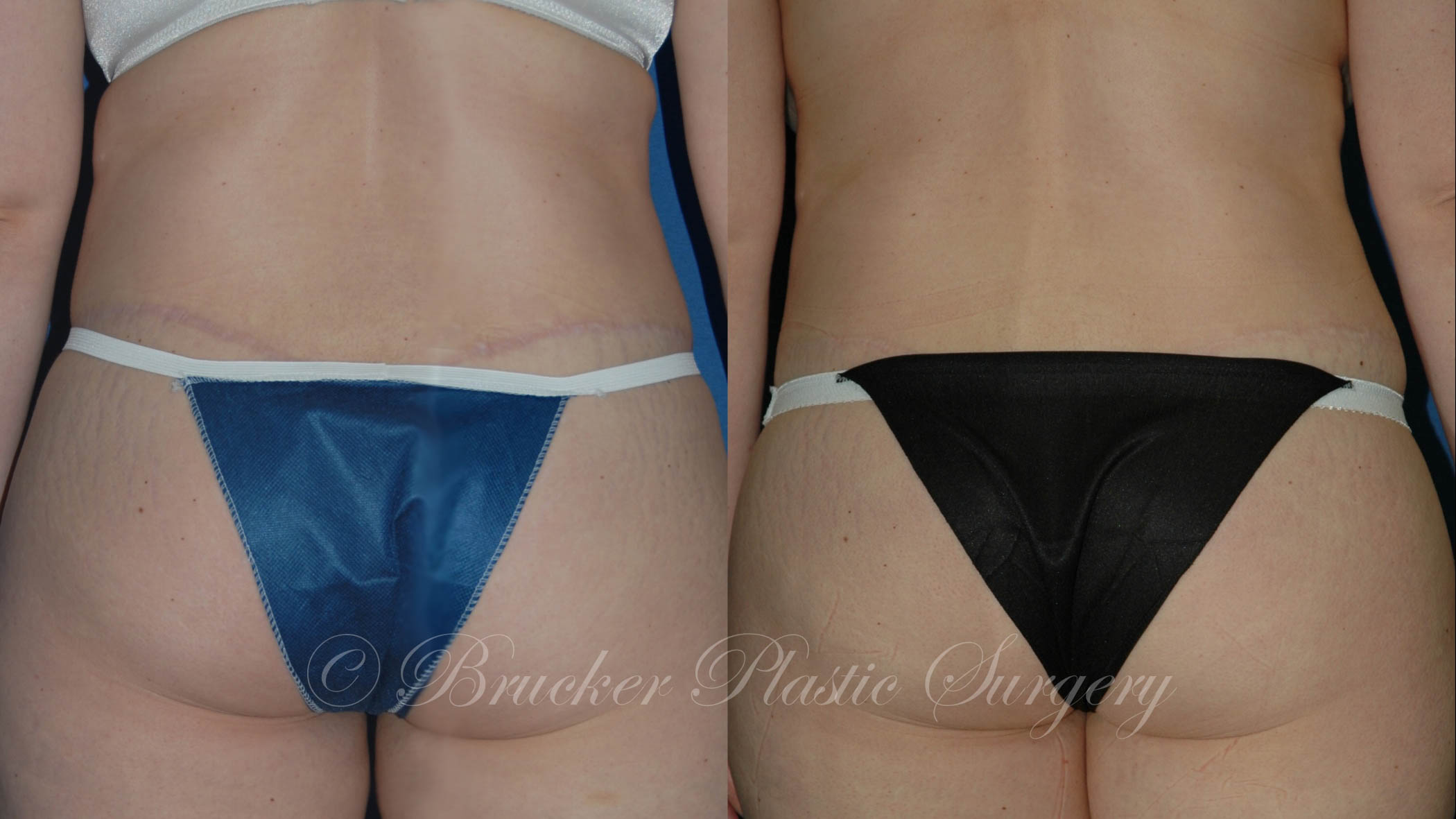 Patient 3e Body Lift Before and After