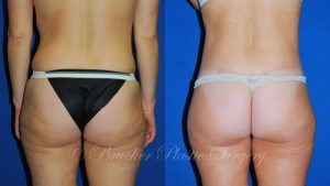 Patient 4a Body Lift Before and After