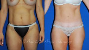 Patient 4b Body Lift Before and After