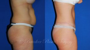 Patient 4c Body Lift Before and After