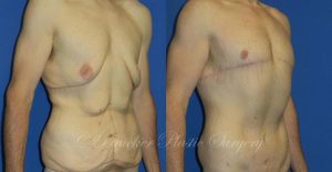 Patient 1b Body Lift Before and After