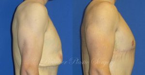 Patient 1c Body Lift Before and After