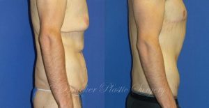 Patient 1d Body Lift Before and After