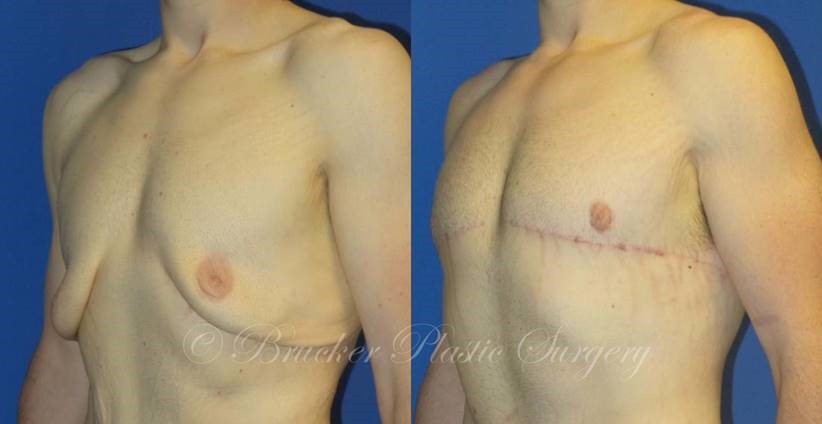 Patient 1e Body Lift Before and After
