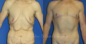 Patient 1g Body Lift Before and After