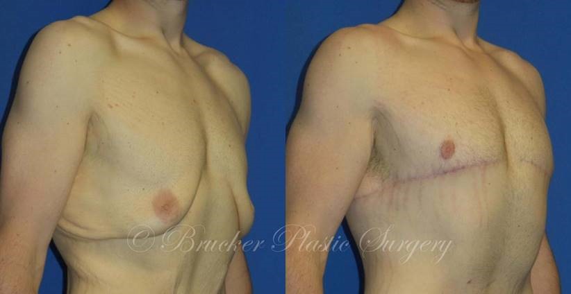 Patient 1a Body Lift Before and After