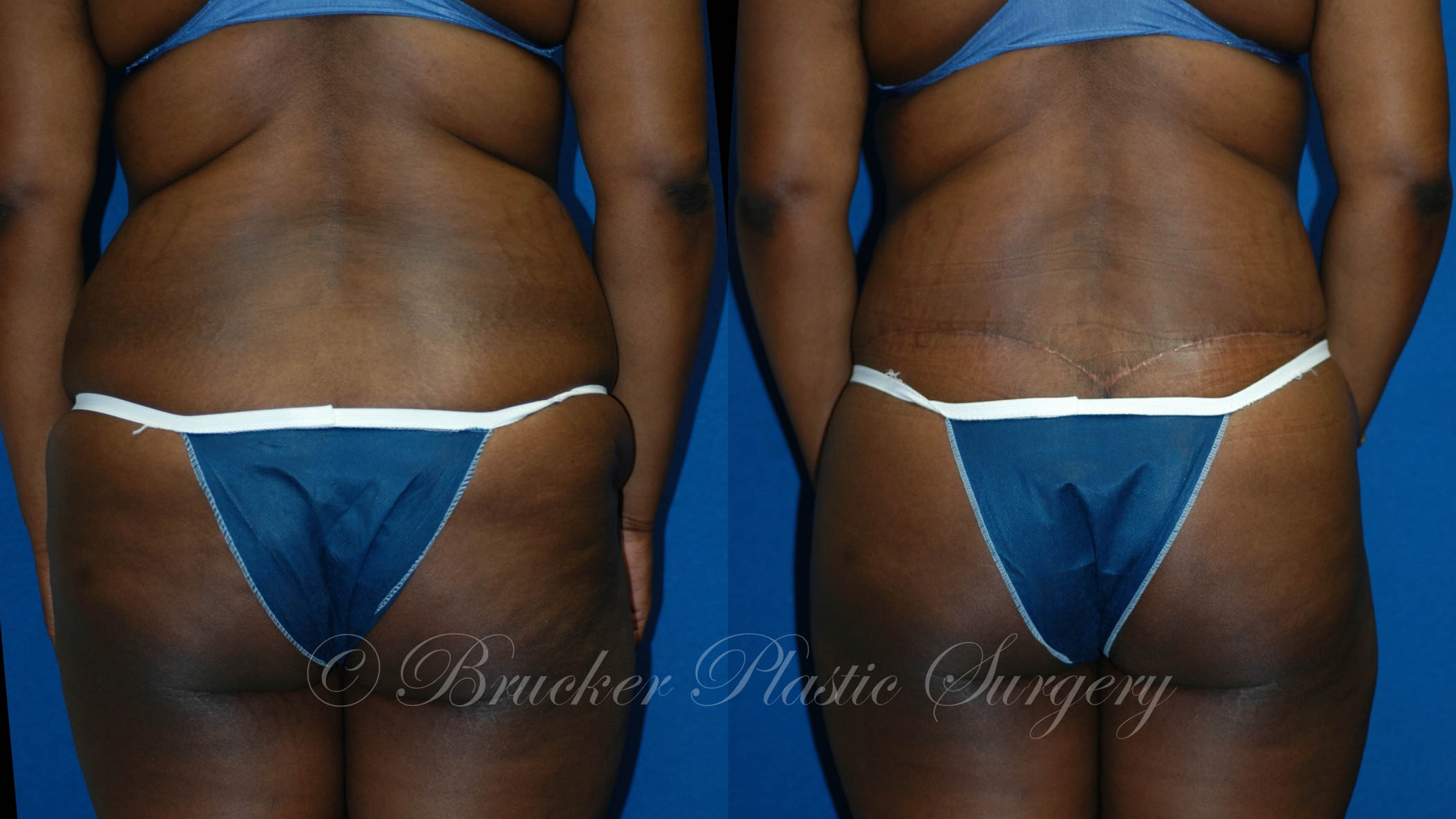 Patient 2b Body Lift Before and After