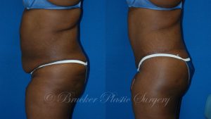 Patient 2c Body Lift Before and After