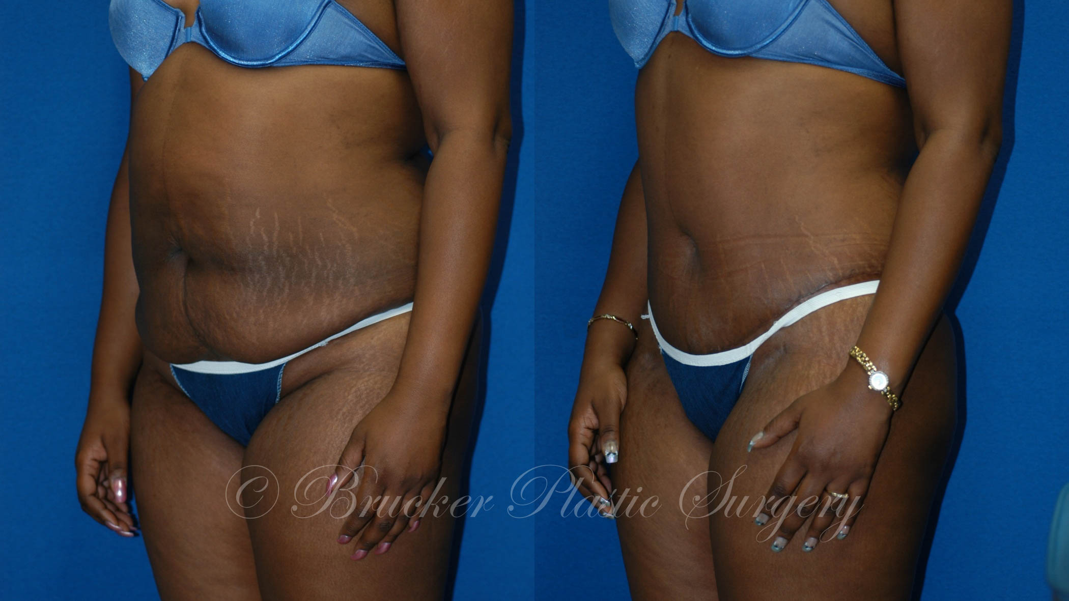 Patient 2d Body Lift Before and After