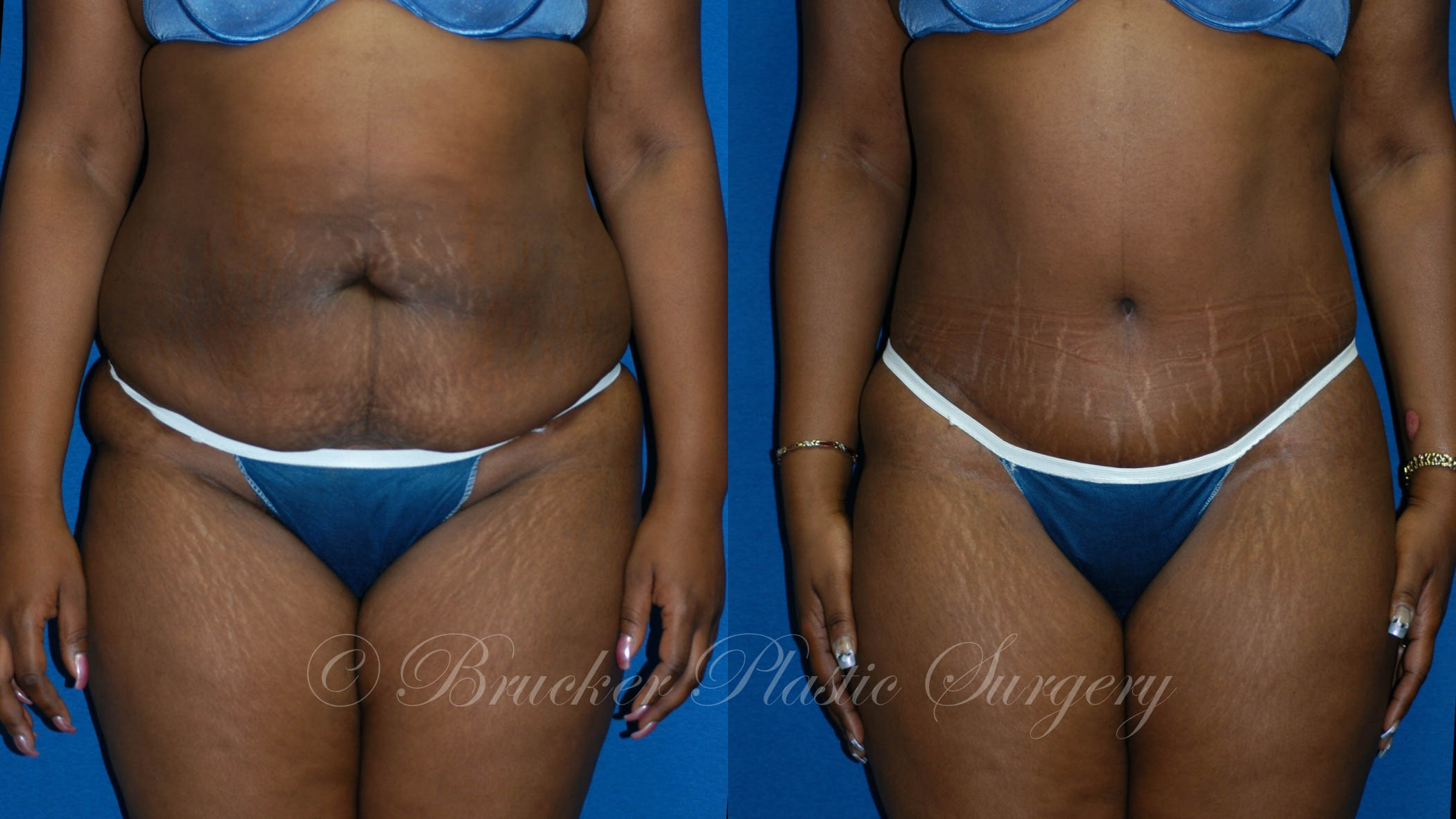 Patient 2a Body Lift Before and After