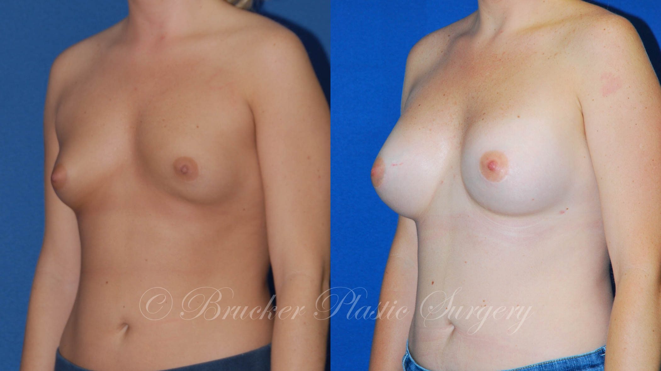 Patient 5b Breast Augmentation Before and After
