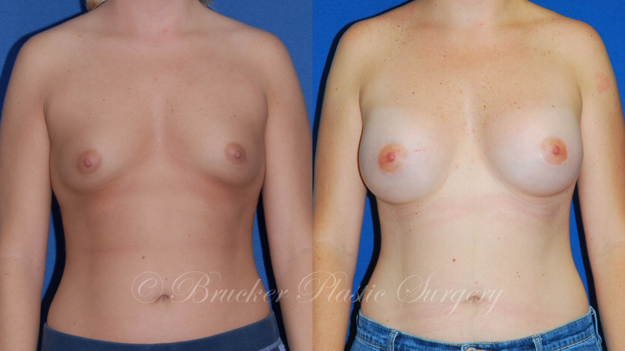 Patient 5a Breast Augmentation Before and After