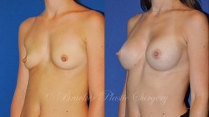 Patient 6b Breast Augmentation Before and After