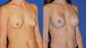 Patient 6c Breast Augmentation Before and After